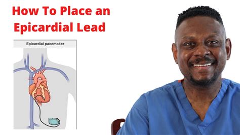 what is an epicardial lead.